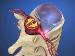 Safe exercises for a herniated disk