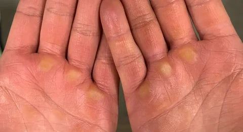 Inside the Callus: Why Your Skin Tears Under Pressure